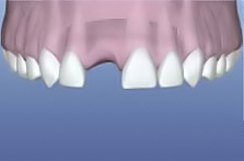implant trước điều trị